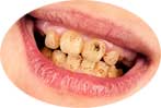 Dientes sucios